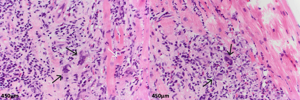 Endomyocardial biopsy specimens of the right ventricle. Hematoxylin and eosin stained photomicrographs (400×) of endomyocardial biopsy sections demonstrate chronic inflammatory infiltrate composed of lymphocytes, histiocytes, and eosinophils, with scattered multinucleated giant cells (black arrows) and foci of myocyte necrosis (white arrow).