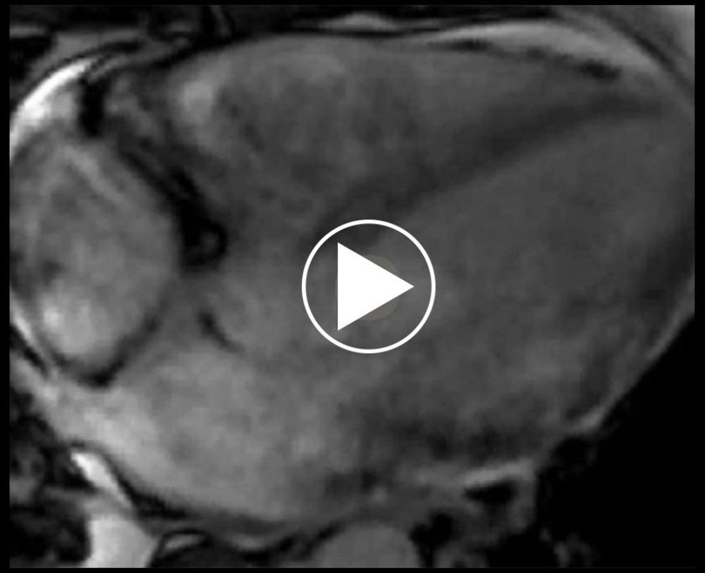 Balanced turbo field-echo magnetic resonance sequence cine clip showing global left ventricular hypokinesis.