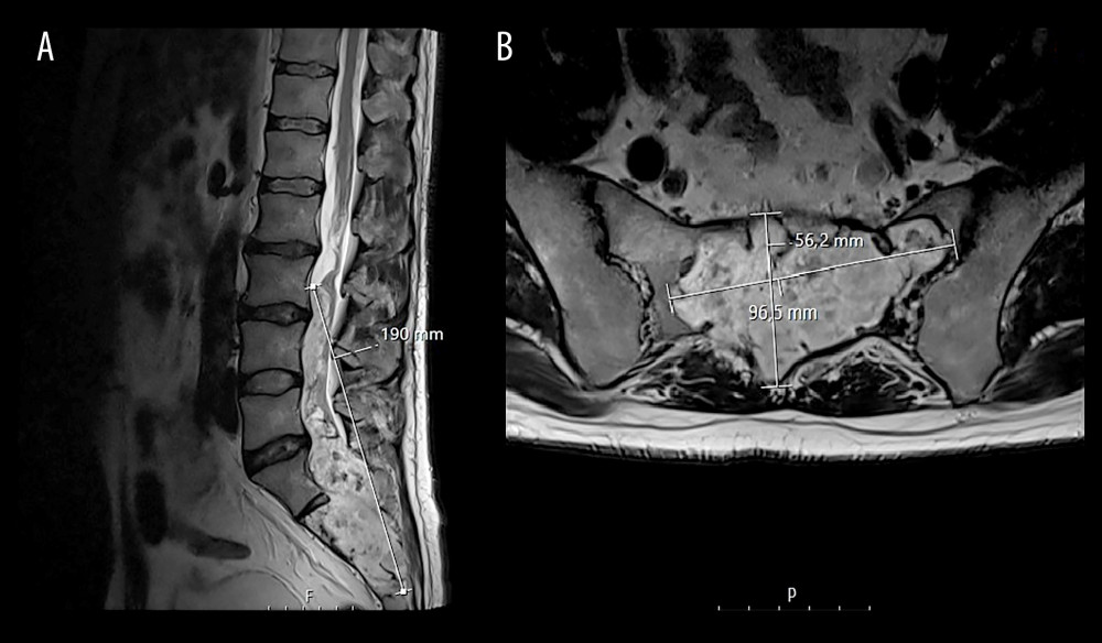 T2-weighted sagittal and axial MRI of the lumbar spine without intravenous contrast. A giant, intradural, extramedullary, heterogeneous, lobulated, expanding tumor was found in the lumbar spine and sacrum canal. Tumor dimensions were 56.2 mm (AP)×96.5 mm (LL)×19.0 mm (craniocaudal). Starting from the L5-S1 level, there was significant erosion of the sacrum, lateral masses more on the left side, expanding the channel, as well as openings with the spread of the presacral and in the back muscles with the incoming nerve root and plexus displacement.