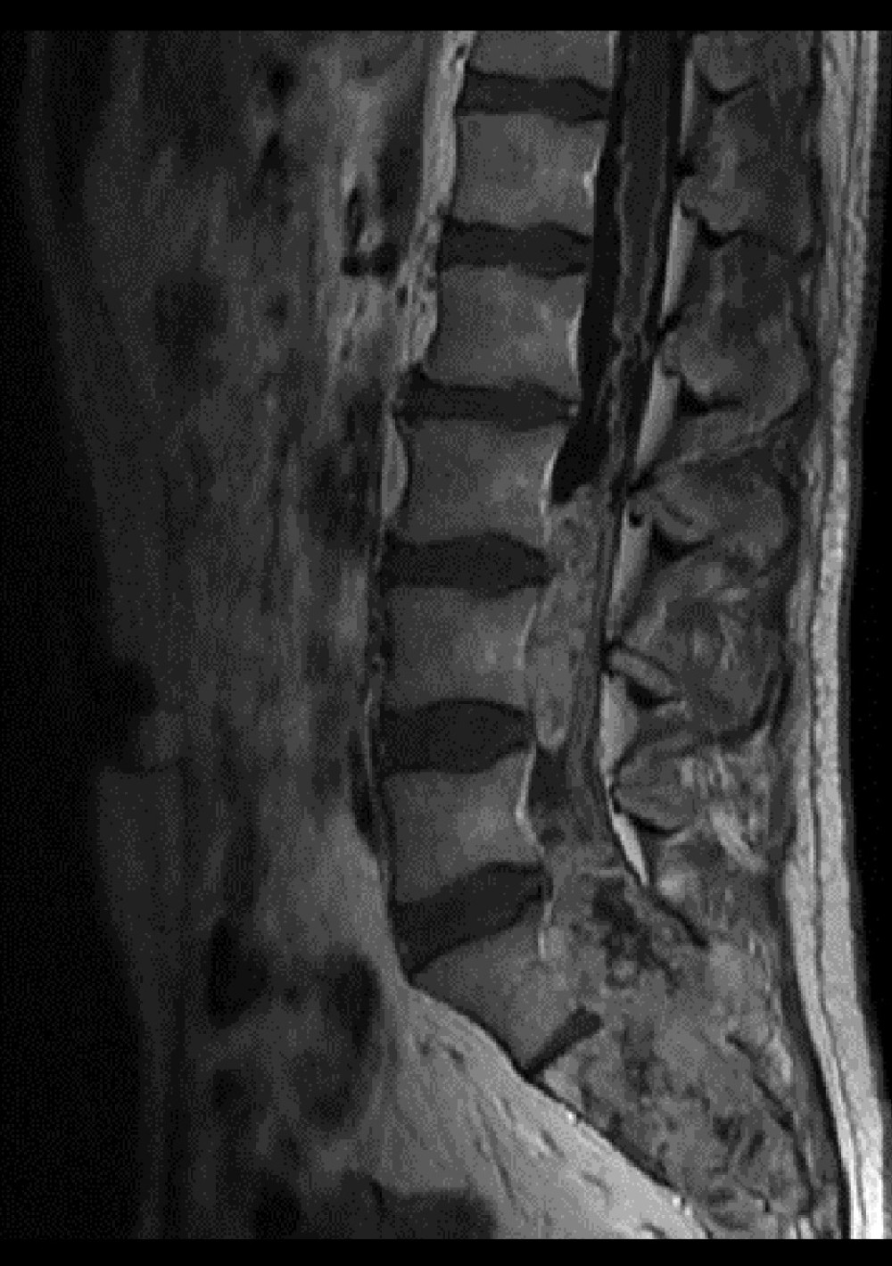 T1-weighted sagittal MRI of the lumbar spine with intravenous contrast administration showing a large, intradural, extramedullary tumor of the lumbar sacrum canal of the spine. The tumor started from the L1 to S3 level. Pathological tissue can also be observed in the end sheaths of the conus medullaris.