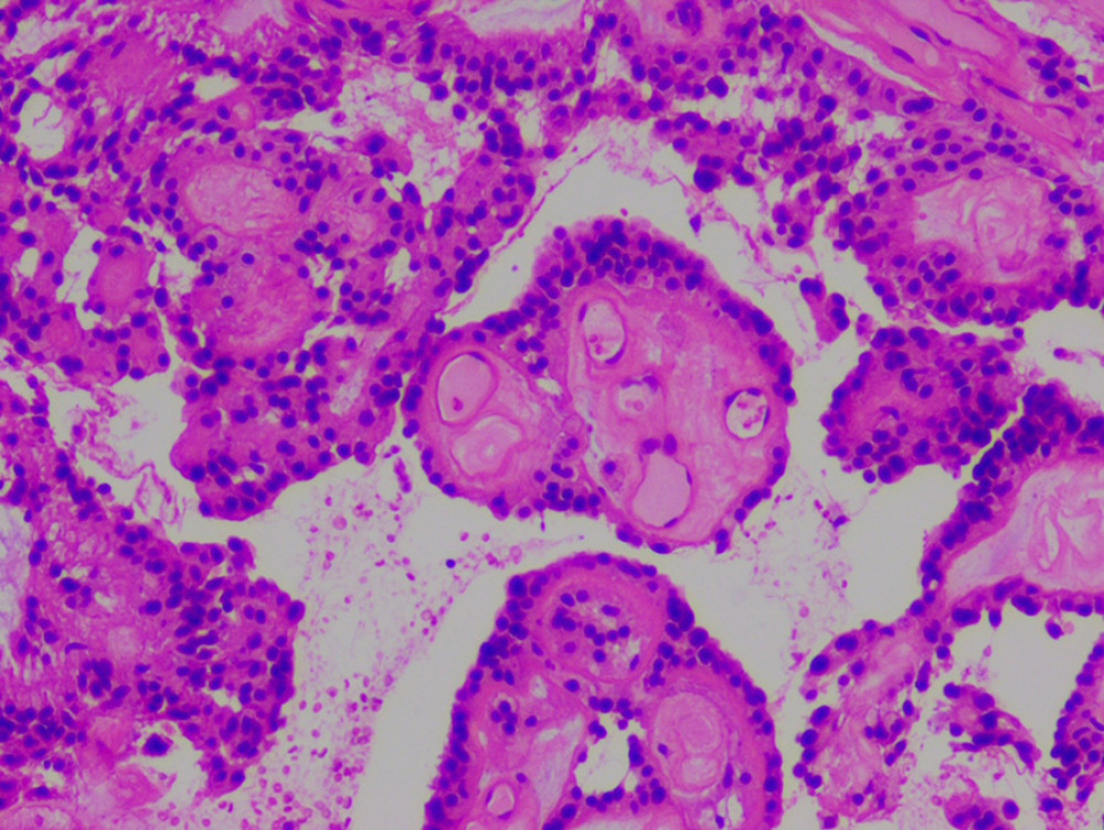 Hematoxylin-eosin staining. The papillary formation exhibits flat-cubic cell coverage on its papillary structures; microcysts with mucinous degeneration are present in the formation.