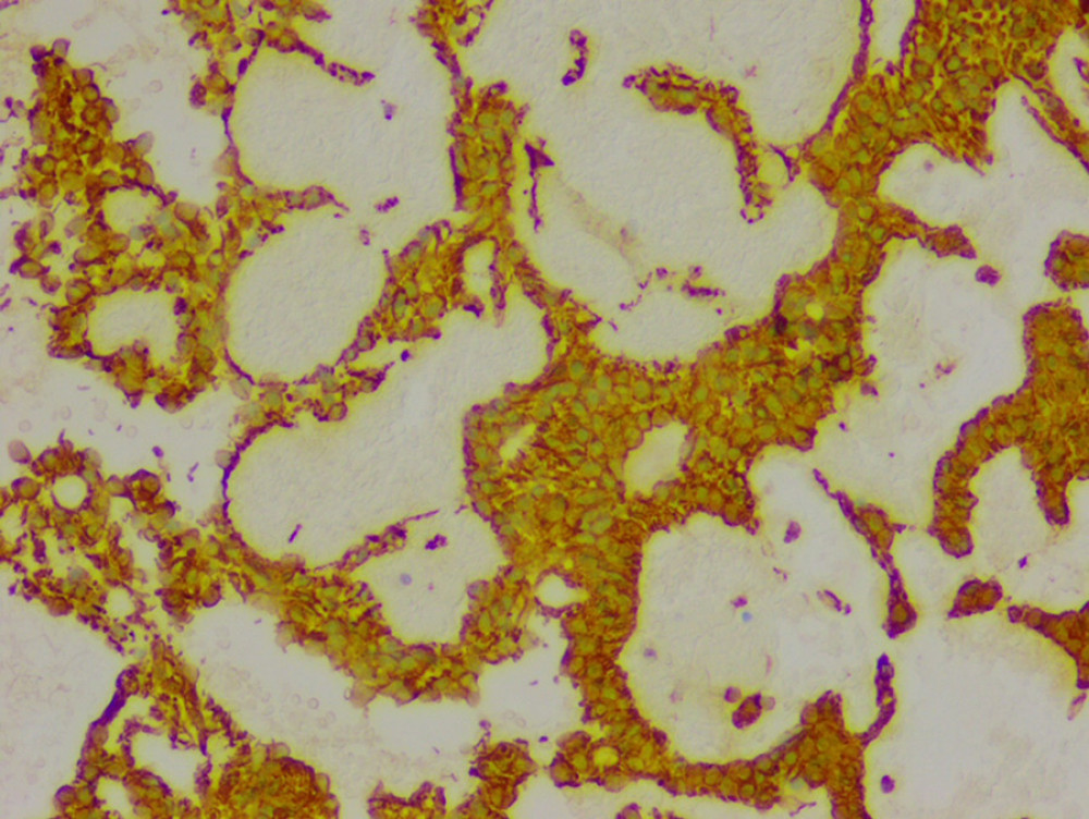 Glial fibrillary acidic protein staining. GFAP expression in tumor cells (×100).