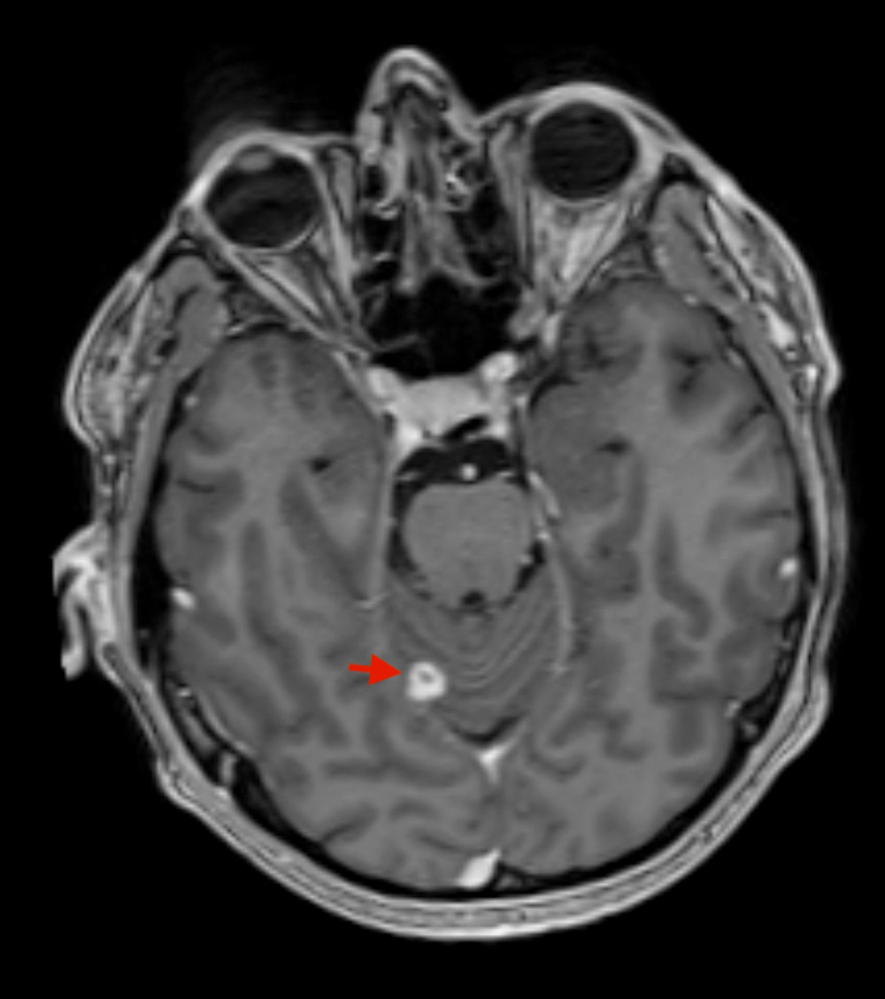 T1-weighted coronal MRI after iv contrast injection before surgery shows a small, 5–6 mm pathological mass, most likely a metastasis, in the right cerebellum in the posterior fossa (arrow).
