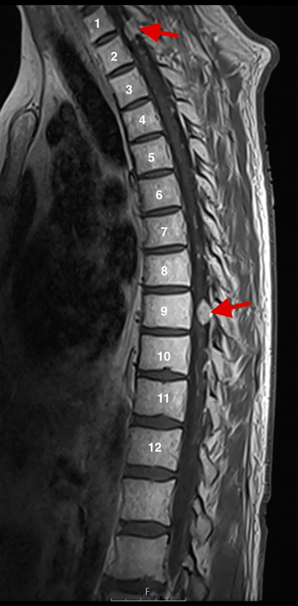 T1-weighted sagittal MRI of thoracic spine with intravenous contrast injection before surgery T1 dix sag C+. Pathological masses, most likely metastases, are seen in the spinal canal in the chest area at C7-Th1, Th1-Th2, and Th10 levels (arrows).
