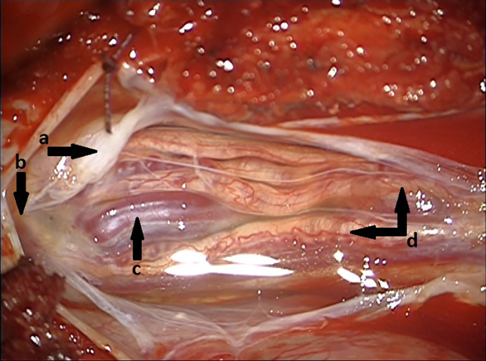 The affected area of the lumbar spine before surgery. (a) dura mater, (b) conus medullaris, (c) ependymoma, (d) nerve roots.