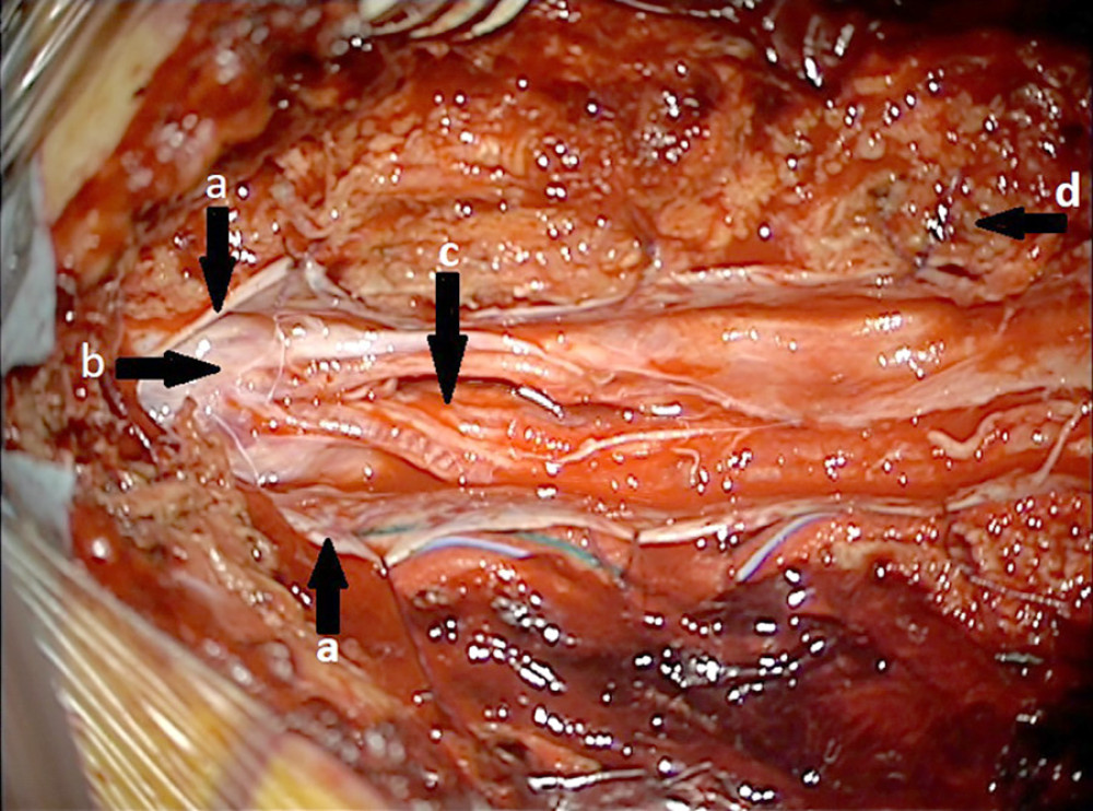 The affected area of the lumbar spine after surgery. (a) dura mater, (b) conus medullaris, (c) surgical site, (d) adipose tissue.