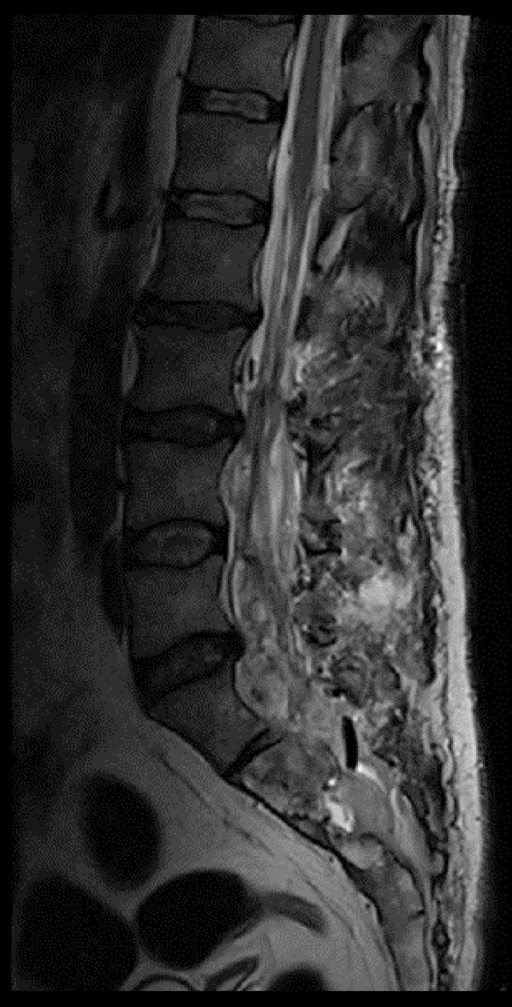 T2-weighted sagittal MRI of the lumbar spine one day after surgery. The tumor has been mostly excised; a small amount of remaining tumor tissue can be observed at the L5-S1 level. The retro-sacral tumor tissue has been completely removed. The surgical wound contains hemorrhagic contents with air pockets.