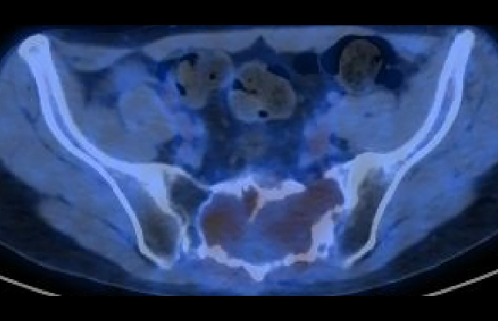 PET/CT axial slices showing pathologic changes in sacrum with slight and moderate uneven hypermetabolism similar to the metabolic background of liver. Standard uptake value in liver was 2.7, but in the lesion in sacrum SUVmax was 2.5.