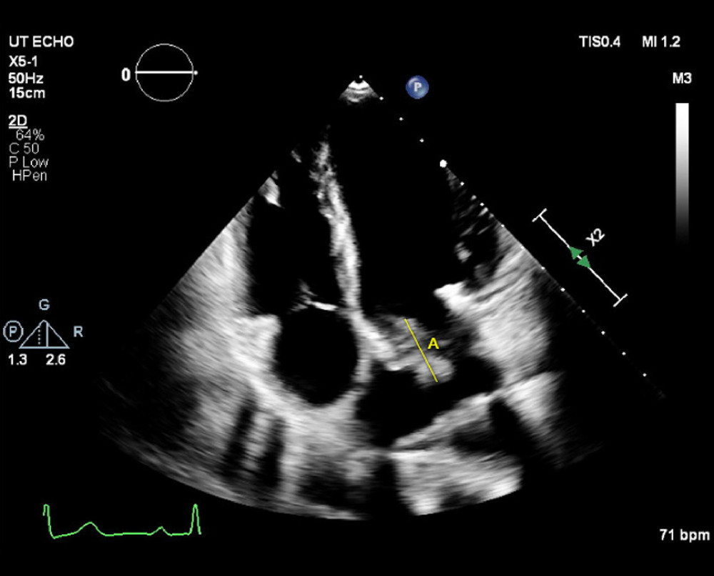 Transthoracic echocardiogram, long-axis 4-chamber view, demonstrating the presence of a vegetation in a mitral bioprosthesis (A).
