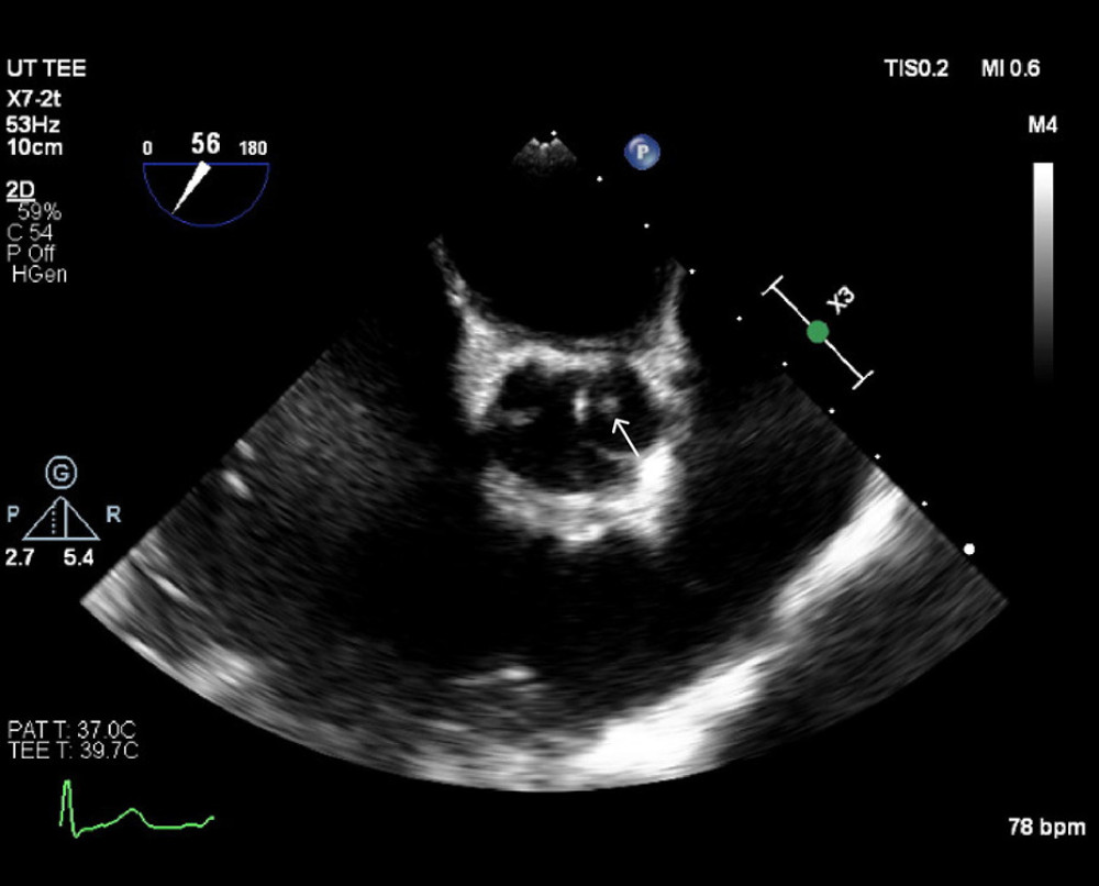 Transesophageal echocardiogram demonstrating the presence of a vegetation in a native aortic valve (arrow).