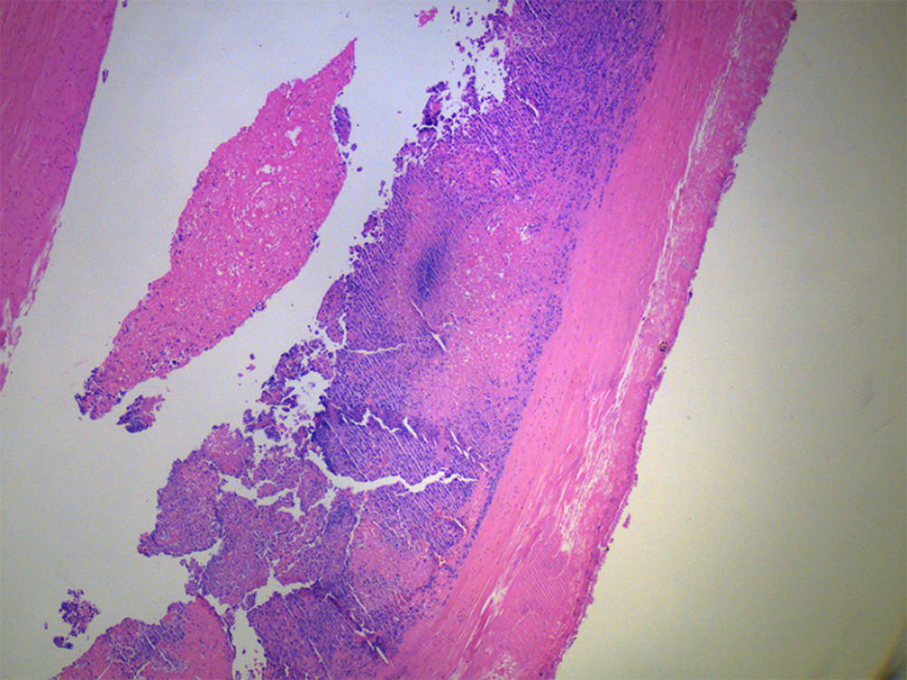 Low power hematoxylin and eosin stain, magnification 40×, showing mitral valvular tissue with marked necrosis and acute inflammation.