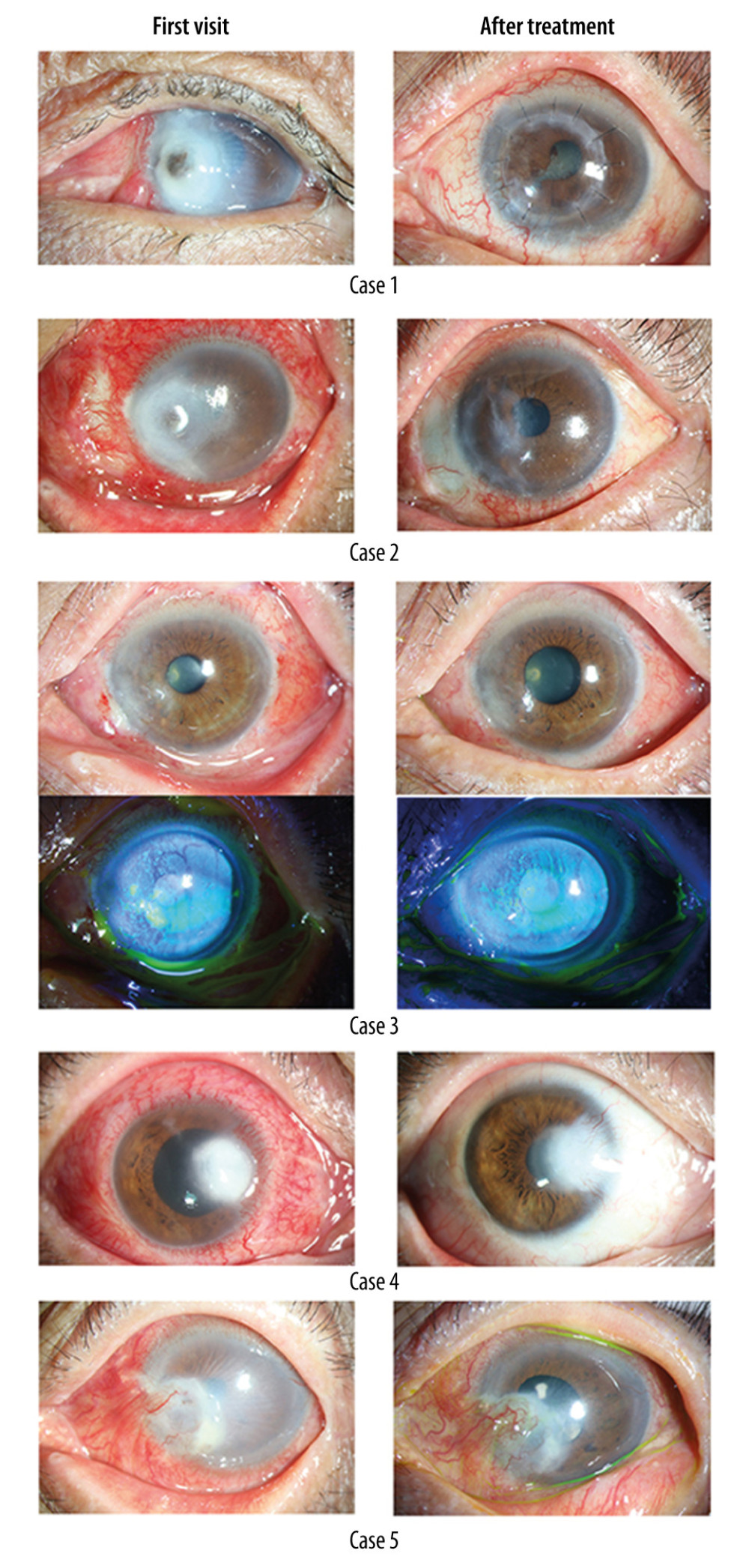 Photographs of 5 patients infected with herpes simplex after pterygium surgery.