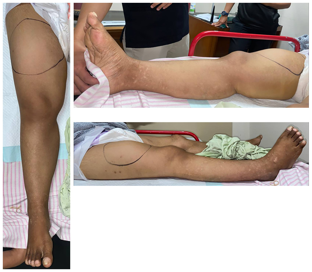 A clinical picture of the right leg. The clinical picture shows a large mass on the right femoral region that felt elastic hard, smooth, and immobile, and measuring 23×20×2.0 cm