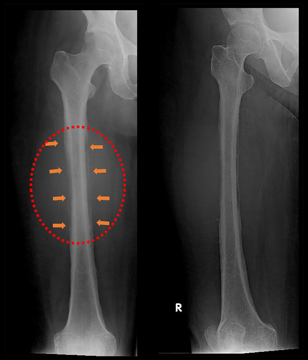 Plain radiograph of femur dextra in anterior-posterior and lateral projection. Radiograph of the right femur revealed a lytic lesion with a permeative pattern and wide zone of transition. A periosteal reaction was also noted, with soft tissue involvement, suggestive of bone sarcoma.