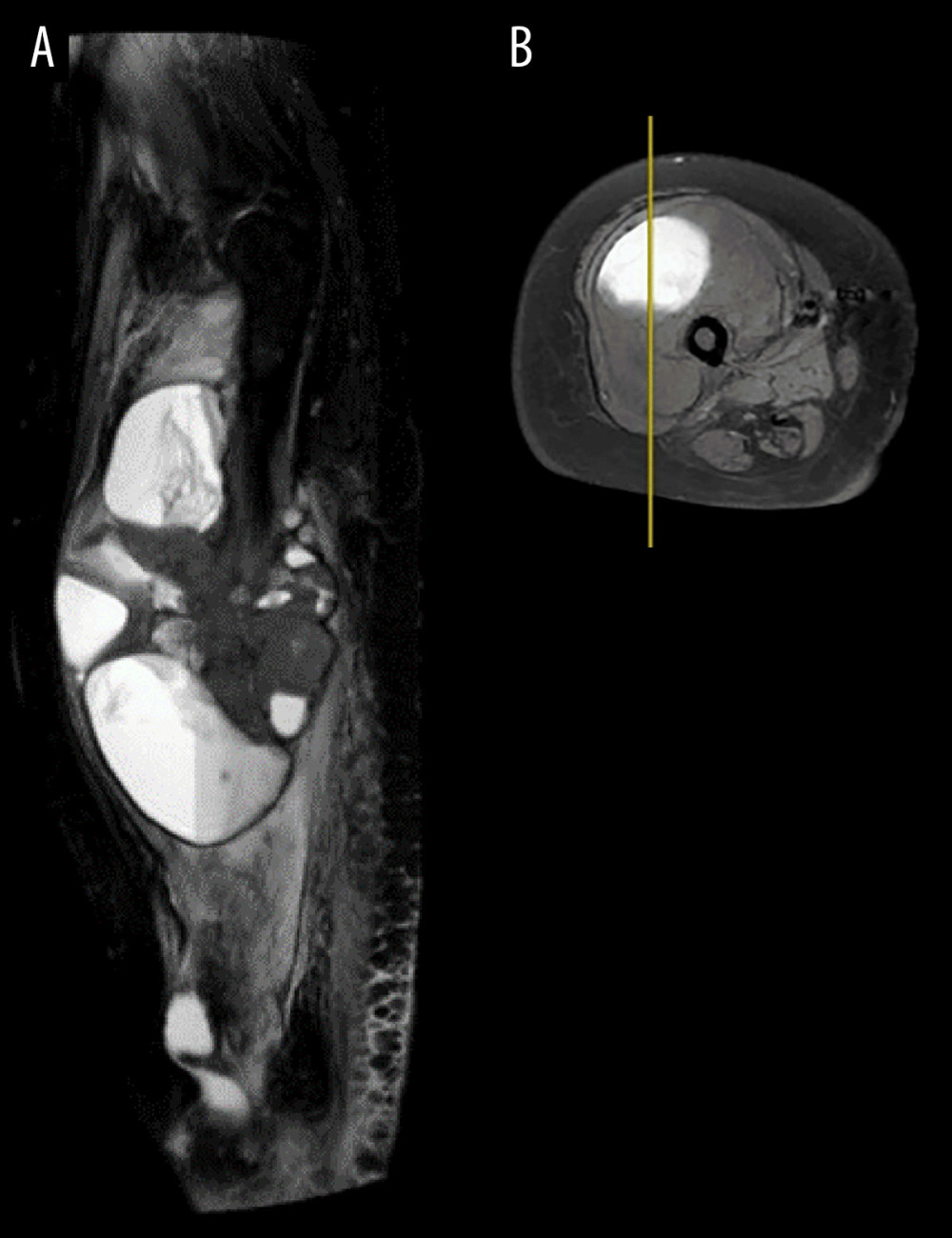 Magnetic resonance imaging (MRI) of the right femur. (A) MRI of the right femur sagittal view shows an inhomogeneous pathologic signal with cystic solid components from vastus medialis, vastus intermedius, and vastus lateralis muscle with the size of 9.41×8.52×16.21 cm. The solid component gave an isohypohyperintense signal at T1 and T2. (B) MRI of the right femur in transverse view.