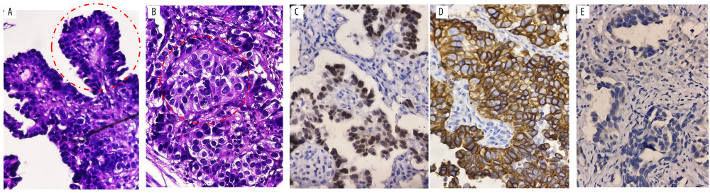 Histopathology results of the right femoral biopsy show metastatic adenocarcinoma. (A) Papillary form. (B) Tumor cells with variable size, lack of cytoplasm, with vacuoles. (C) Immunohistochemistry (IHC) staining showed positive result, with TTF 1. (D) IHC staining showed positive result, with cytokeratin 7. (E) IHC staining showed negative result, with thyroglobulin.