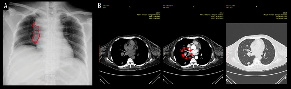 Chest radiograph of the patient. (A) Chest radiograph, with opaque lesion indicative of a mediastinal mass (outlined by red line). (B) Chest computed tomography scan showed infiltration of the trachea (red dashed line).