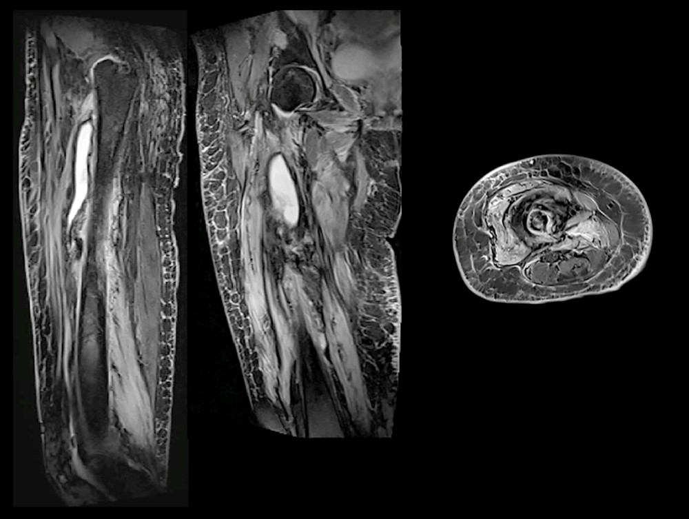Magnetic resonance imaging of the right femur 6 months after therapy shows significantly reduced lesion (around 59%), mainly on vastus medius.