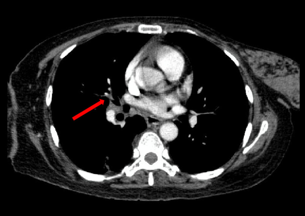 Thorax computed tomography scan 9 months after therapy shows the pulmonary lesion showed partial response to the therapy.