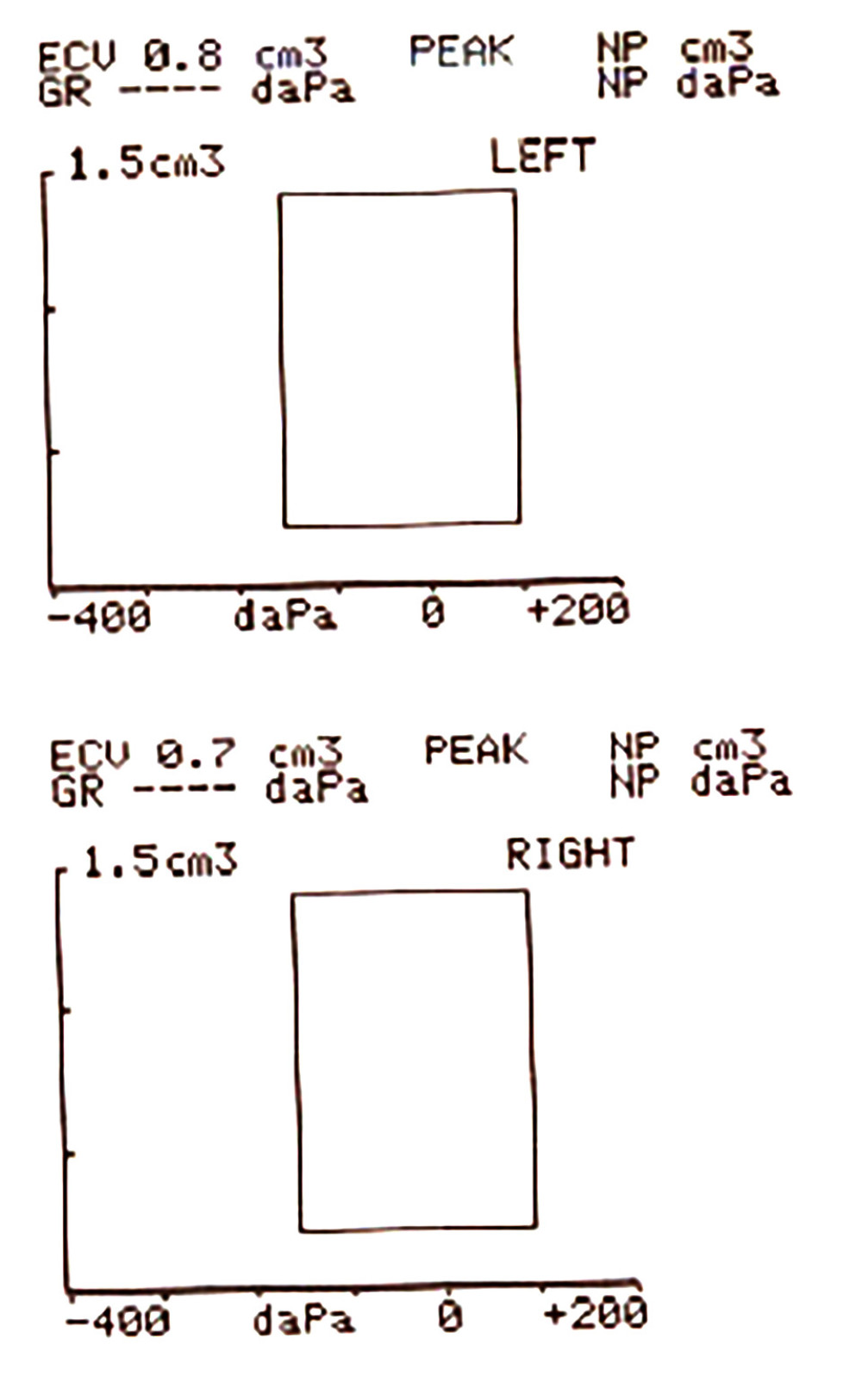 Pre-treatment tympanometry was flat/type B consistent with otitis media with effusion.