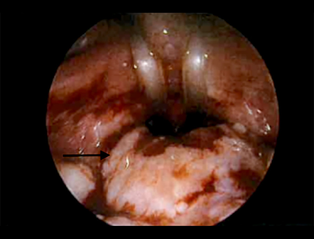 Intraoperative endoscopy showing enlarged adenoids obstructing the choanae with overlying white exudate (black arrow).