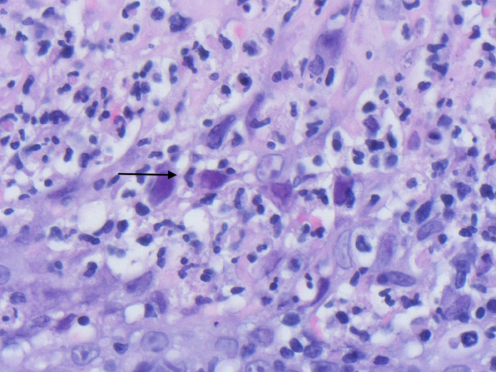 Viral cytopathic effect (black arrow) seen on biopsy of adenoid (×600 magnification).
