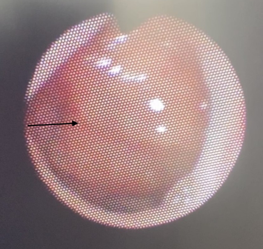 Post-treatment nasendoscopy showing residual adenoid (black arrow) without exudate or obstruction.