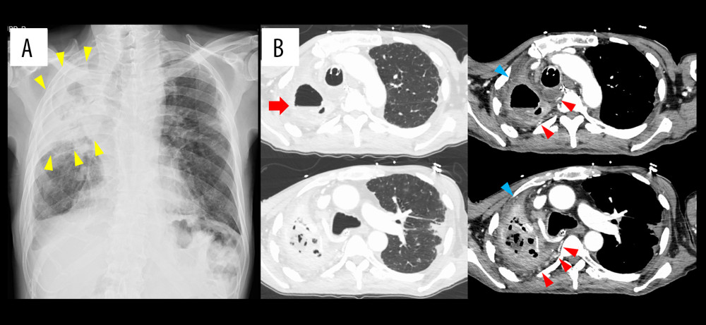 Chest imaging findings during the appearance of massive hemoptysis. (A) Chest radiography upon admission showing infiltration in the right upper lung field (yellow arrowhead). (B) Chest computed tomography showing a large mass in the apical portion of the right lung, constituting apical pleural thickening and an encapsulated pleural effusion (arrow). Additionally, the mass had enlarged over time. The bronchial artery was enlarged and contiguous with the lesion along the dorsal pleura (red arrowhead). The lesion was also accompanied by an increase in vascular growth along the ventral pleura, which may have originated from a source other than the bronchial artery (blue arrowhead).