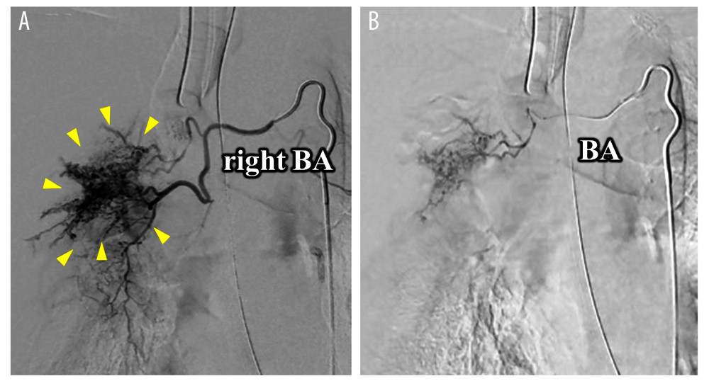 Comparison of bronchial arteriography findings frontal views before and after bronchial artery embolization. (A) Digitally subtracted angiography demonstrated that the right bronchial arteries were abnormal, with hypertrophy and peripheral bronchopulmonary shunt (yellow triangle). (B) After embolization of the right bronchial artery with use of porous gelatin particles (Gelpart, Nippon Kayaku, Tokyo, Japan), digitally subtracted angiography indicated a reduction in blood flow through the abnormal right bronchial arteries. BA – bronchial artery.