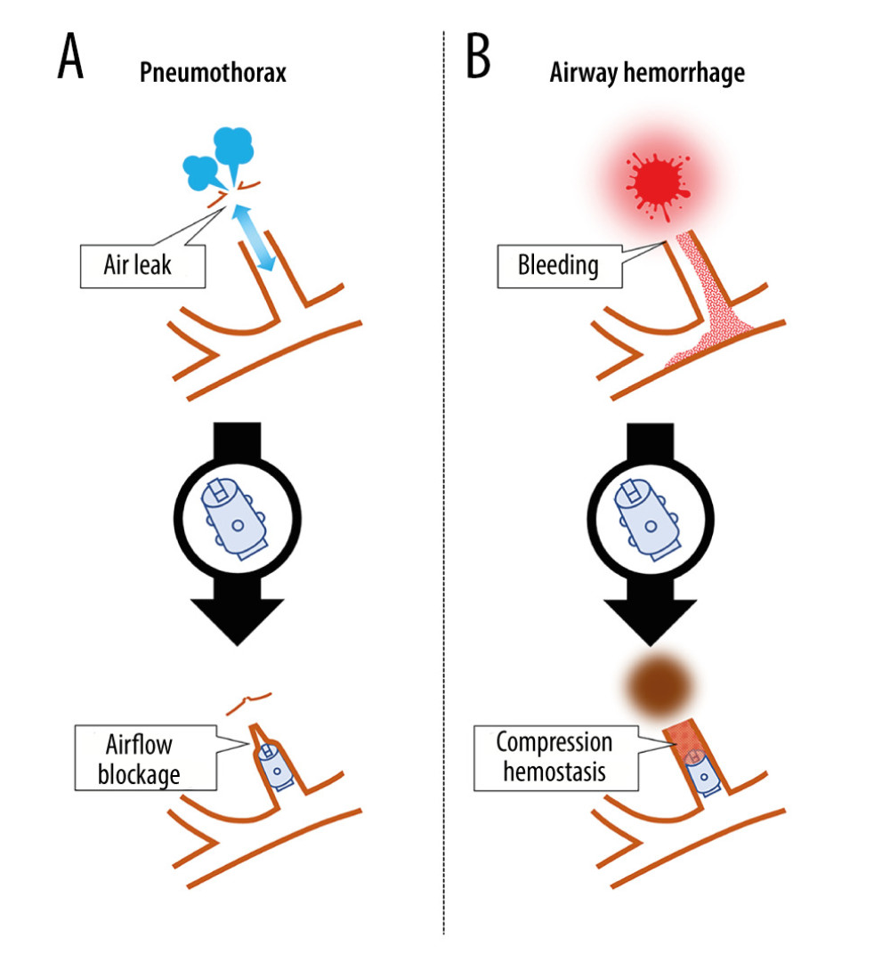 Mechanism of endoscopic bronchial occlusion with an endobronchial Watanabe spigot (EWS) in pneumothorax and hemoptysis. (A) In the treatment of pneumothorax, the EWS is inserted into the bronchus responsible for the air leak to occlude that bronchus. This occlusion prevents airflow through the lung fistula and assists in closing the fistula. (B) In the treatment of airway hemorrhage, the EWS is inserted into the bleeding bronchus to stop the outflow of blood to other bronchi. In addition, the occluded bronchus fills with blood and coagulates, resulting in compression hemostasis.