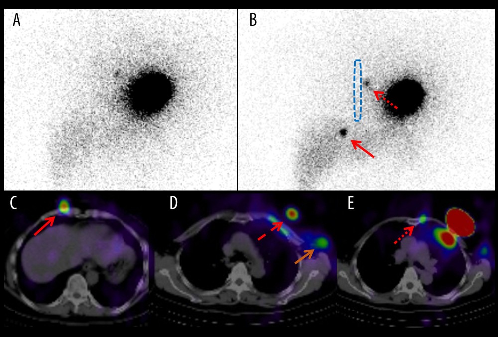 Breast-conserving surgery (BCS) plus sentinel node biopsy (SNB) was performed 18 years ago (Patient 1). (A, B) Planar images and at 15 min and at 3 h, respectively. (C–E) All SPECT/CT images at 3 h. (A) No obvious second sentinel lymph node exists (SLN). (B) Second sentinel nodes (SNs) were detected in the contralateral (red arrow) and the ipsilateral internal mammary lymph node (LN) (dotted red arrow). gThe blue dotted line indicates the sternum. (C) Contralateral internal mammary LN was detected (red arrow). (D) Intramammary LN had a dominant accumulation of isotope (dashed red arrow) and ipsilateral axillar LN (brown solid arrow). (E) Ipsilateral internal mammary LN was detected (dotted red arrow).