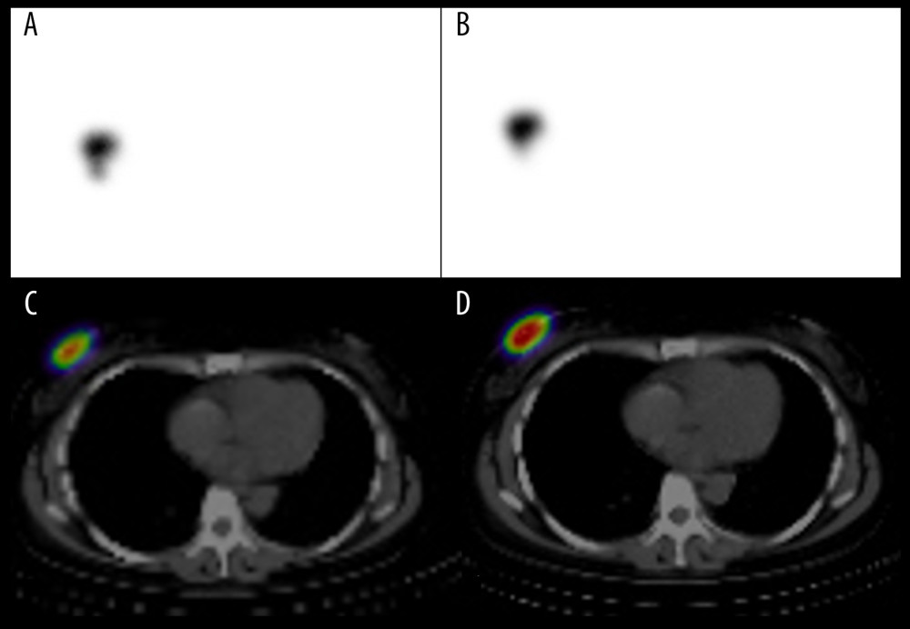 The patient (Patient 2) was diagnosed with triple-negative breast cancer that was clinically node-negative. Sentinel node biopsy (SNB) was performed initially, followed by chemotherapy. However, the tumor progressed rapidly, so the treatment was changed to surgery. Lymphoscintigraphy and single-photon emission computed tomography (SPECT/CT) showed no second sentinel node (SN). The front and oblique views of planar images (A, B, respectively). SPECT/CT images (C, D). Images taken at 15 min after 99mTc-phytate injection (A, C) and at 3 h (B, D). Accumulation observed only at the isotope injection point.