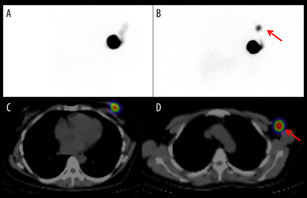 The initial surgery was breast-conserving surgery (BCS) plus sentinel node biopsy (SNB) 14.5 years ago without radiotherapy (Patient 4). Lymphoscintigraphy and single-photon emission computed tomography (SPECT/CT) showed radioisotope accumulation only in the ipsilateral axilla at 3 h after 99mTc-phytate injection. An oblique planar image in early (A) and delayed phases (B). The red arrow indicates an accumulation in the axillary lymph node. SPECT/CT image at 15 min showing only injection site (C) and the late phase in SPECT/CT (D), and isotope was accumulated in the axilla (red arrow).