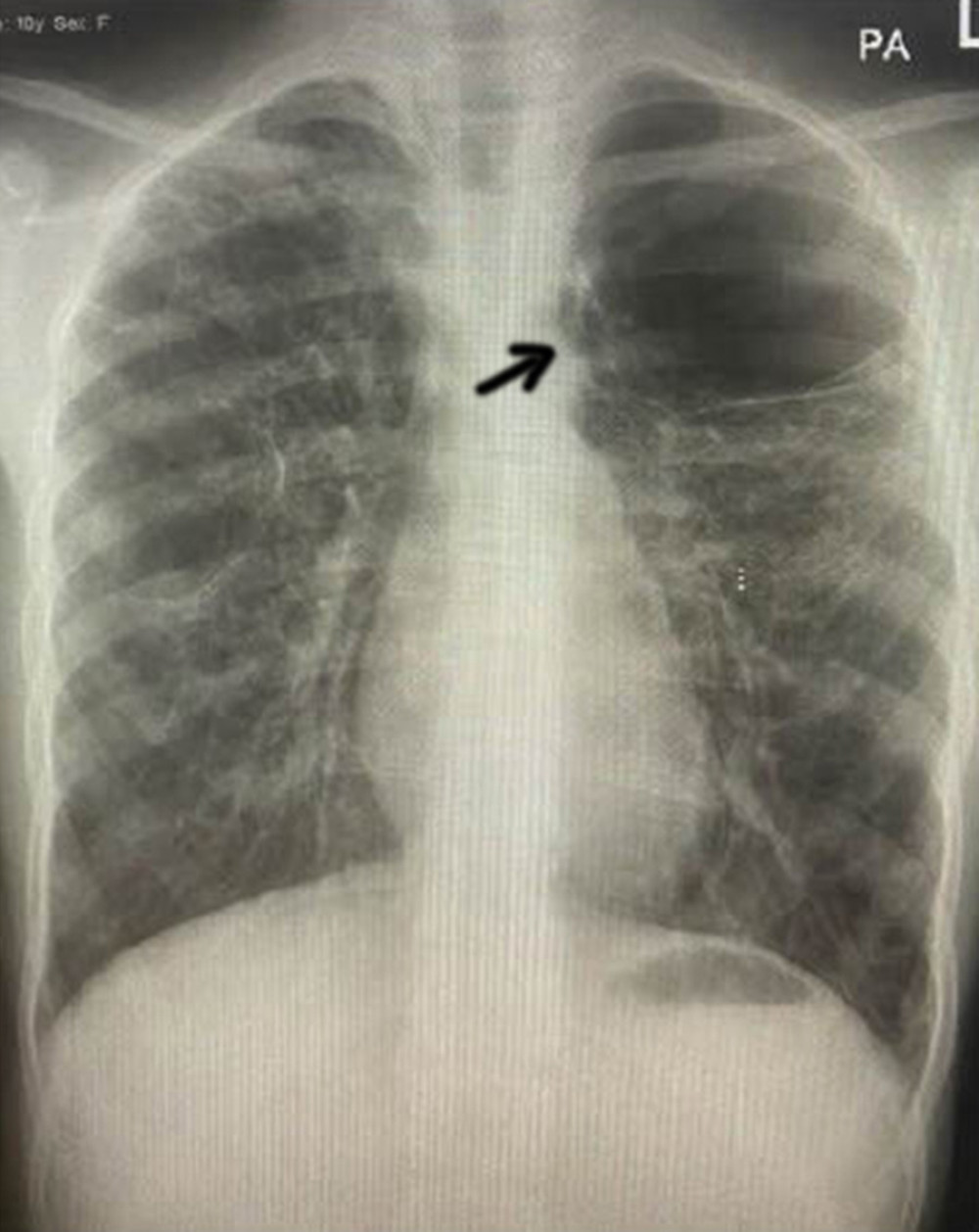 Chest X-ray with marked hyperinflation and marked radiolucency in the left upper zone, with no vascular vessels suggestive of a localized cyst (black arrow). Furthermore, multiple cavitations in the right upper and middle zones were observed.