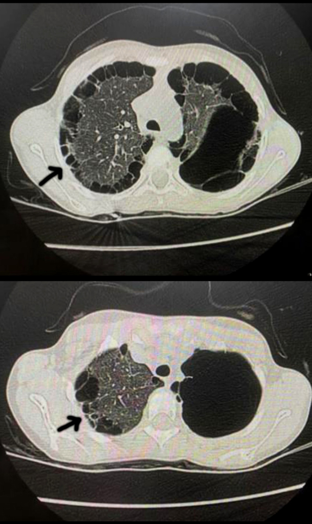 Axial chest CTs at different levels showing numerous subpleural (black arrows) and intraparenchymal lung cysts, worse on the left upper lobe.