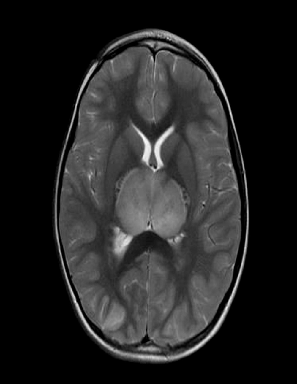 Brain MRI transverse relaxation time (T2) sequence axial view showing extensive symmetrical bilateral thalamic swelling.