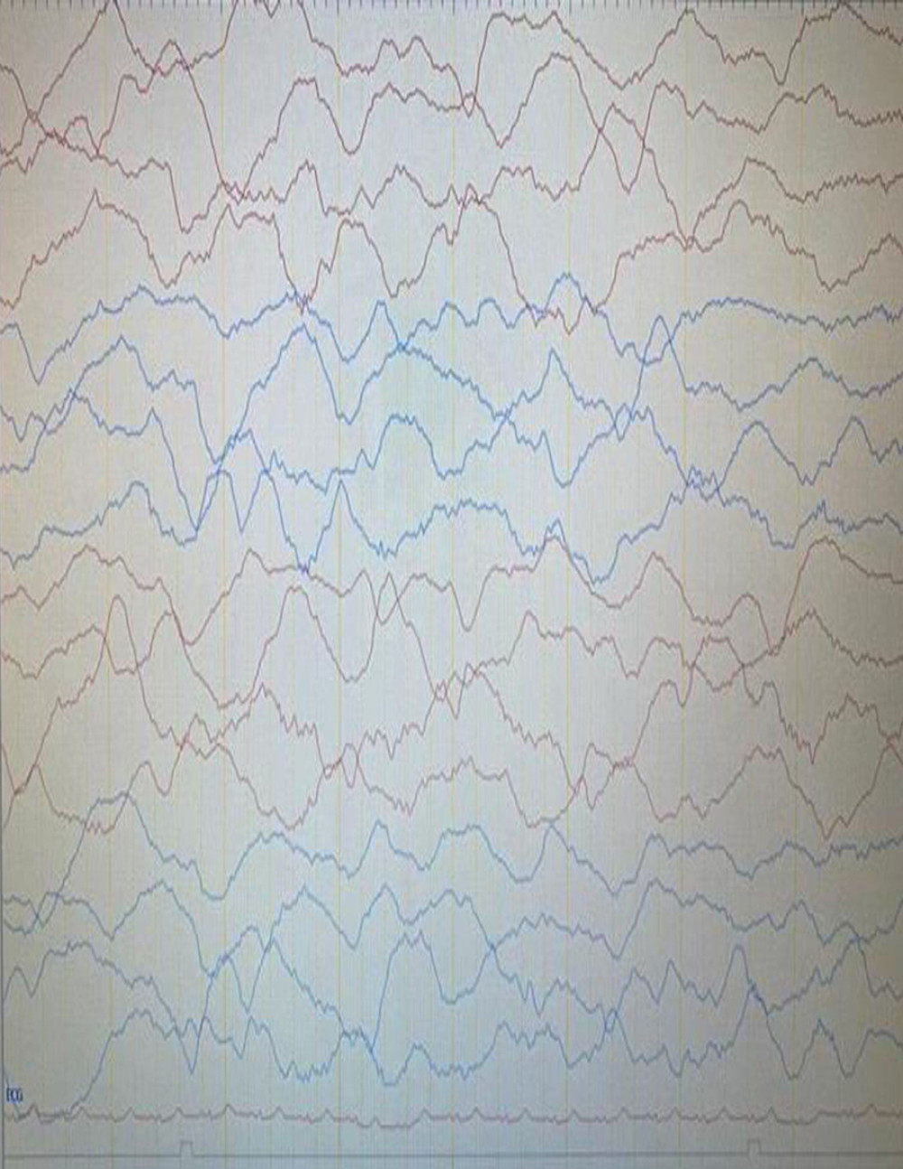 Initial EEG showed an encephalopathic picture.