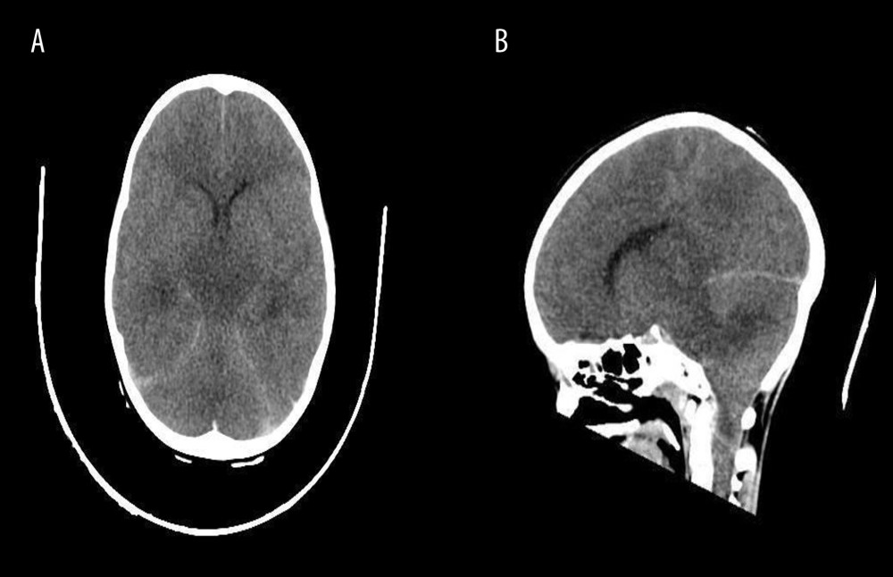 (A) Brain CT axial view showing significant edema. (B) CT brain sagittal view showing marked brain edema with tonsillar herniation.