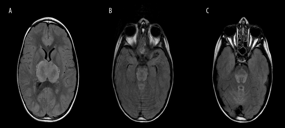 (A–C) MRI brain fluid attenuated inversion recovery (FLAIR) sequence showing widespread brainstem lesions with microhemorrhages and hemorrhagic necrosis.