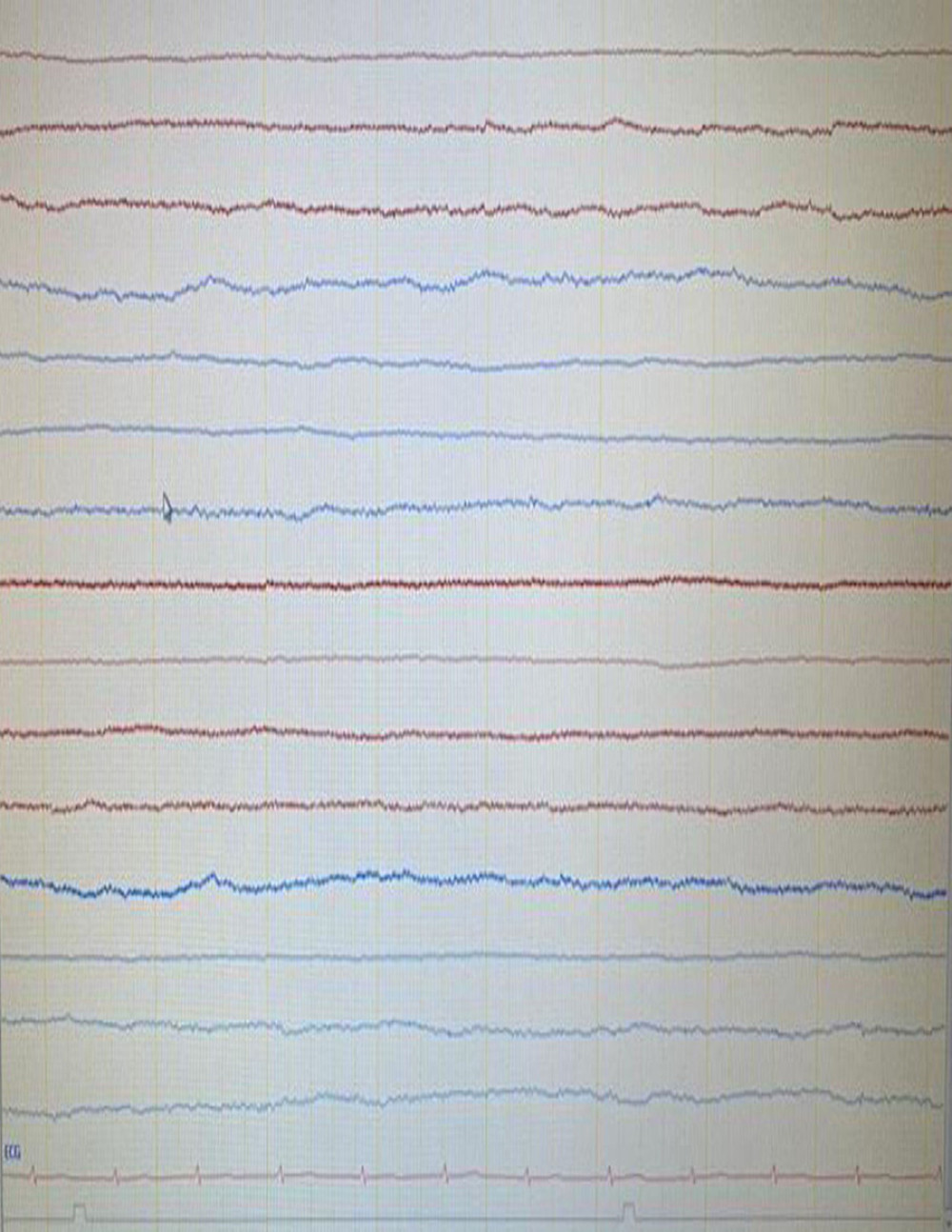 Electroencephalogram EEG showing isoelectric findings.