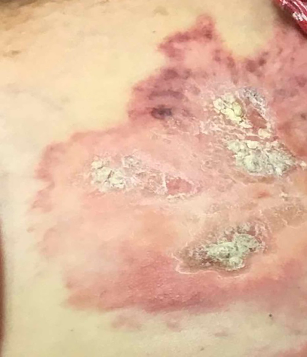 Cutaneous metastatic lobular carcinoma, 20×13 cm, erythematous, indurated, fibrotic plaque that covered most of the patient’s left anterior superior chest wall. The left side of the image is the patient’s left sternal border, and the crusting and area of increased erythema is the patient’s lateral chest well. The patient had a mastectomy previously, and this lesion covered the area where her left breast would have been.