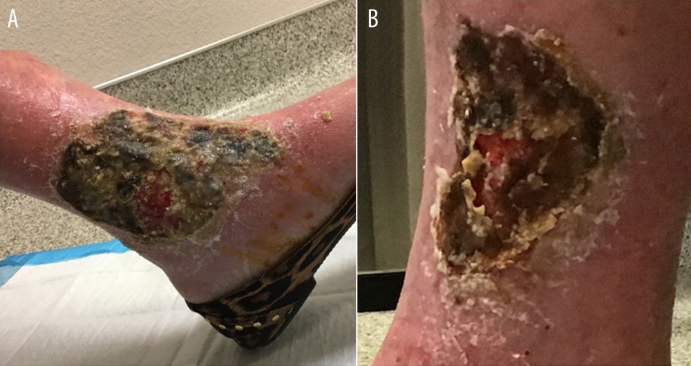 (A, B) Four 12×8 cm ulcerations were found on the medial and lateral portions of both ankles. The lesions on her extremities presented as erythematous, friable, bleeding, indurated ulcers with a well demarcated border and undermining of the leading edge.