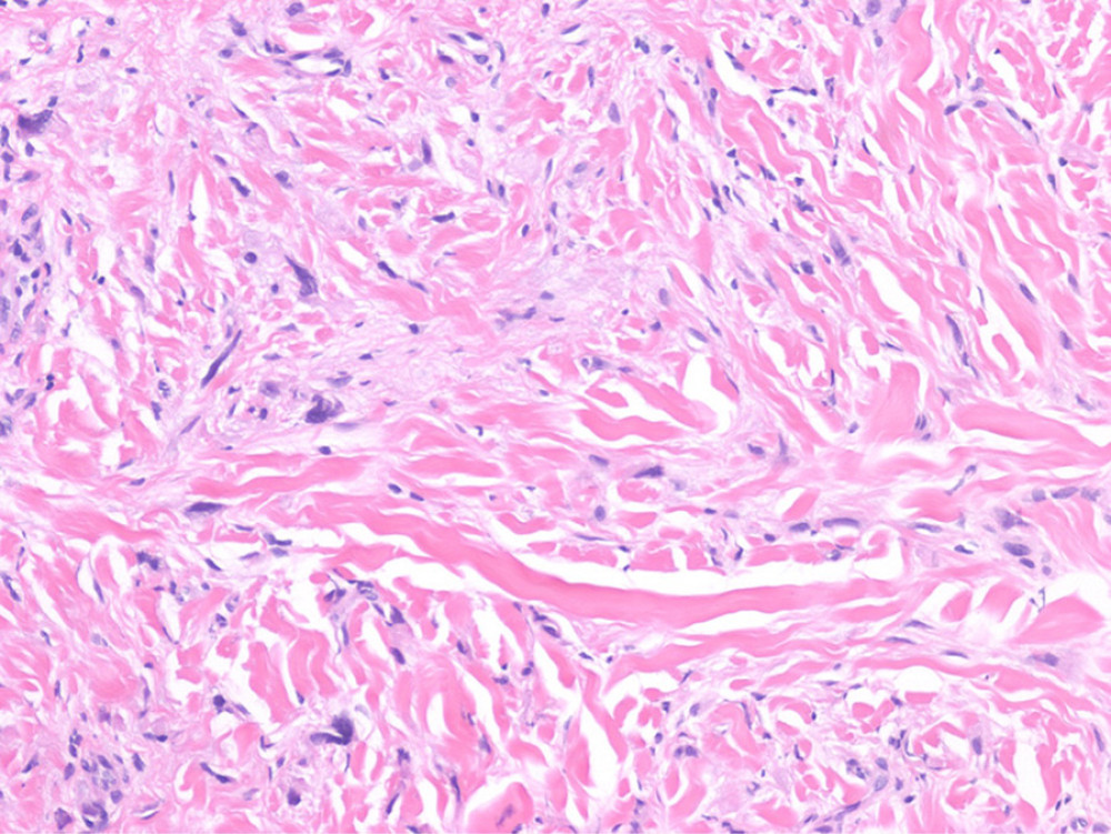 (×20; HE). Punch biopsy of the left medial chest wall depicting metastatic lobular carcinoma with lymphovascular invasion. The carcinoma was positive for polyclonal keratin and negative for E-cadherin.