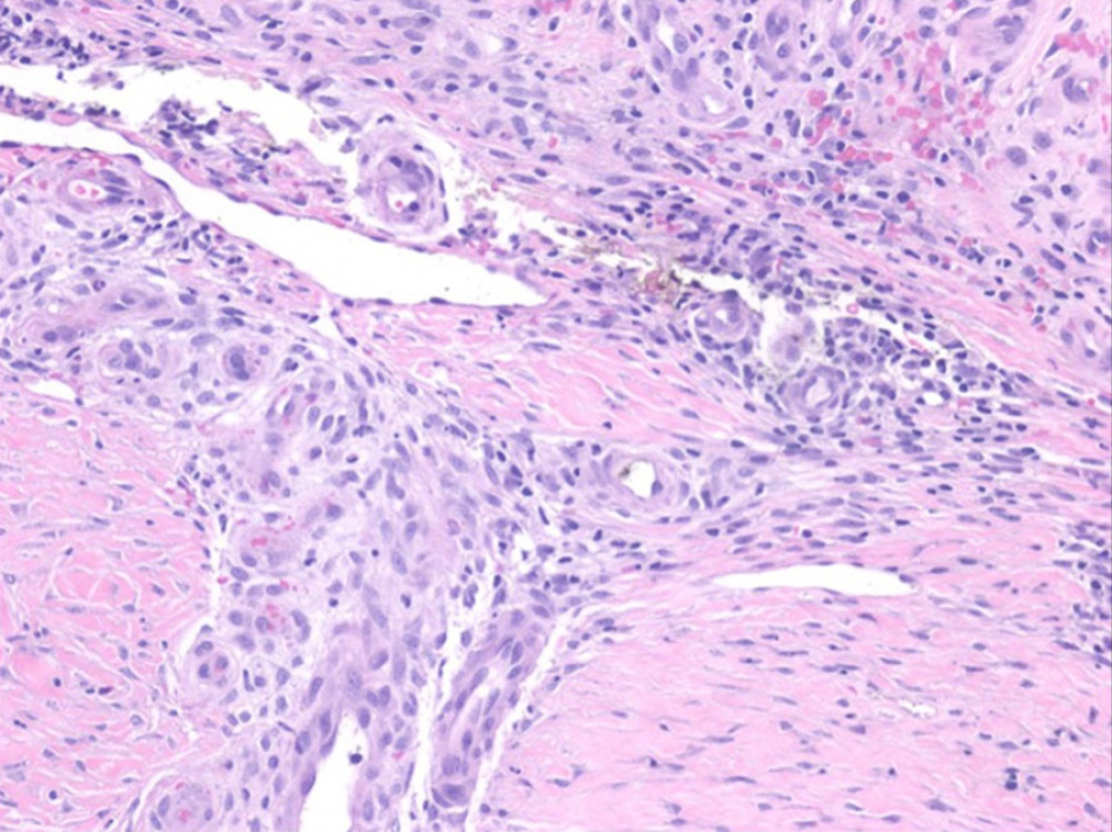 (×20; HE). Shave biopsy of the left lower leg showing ulceration with fibrosis and reactive epidermal changes consistent with a diagnosis of pyoderma gangrenosum.