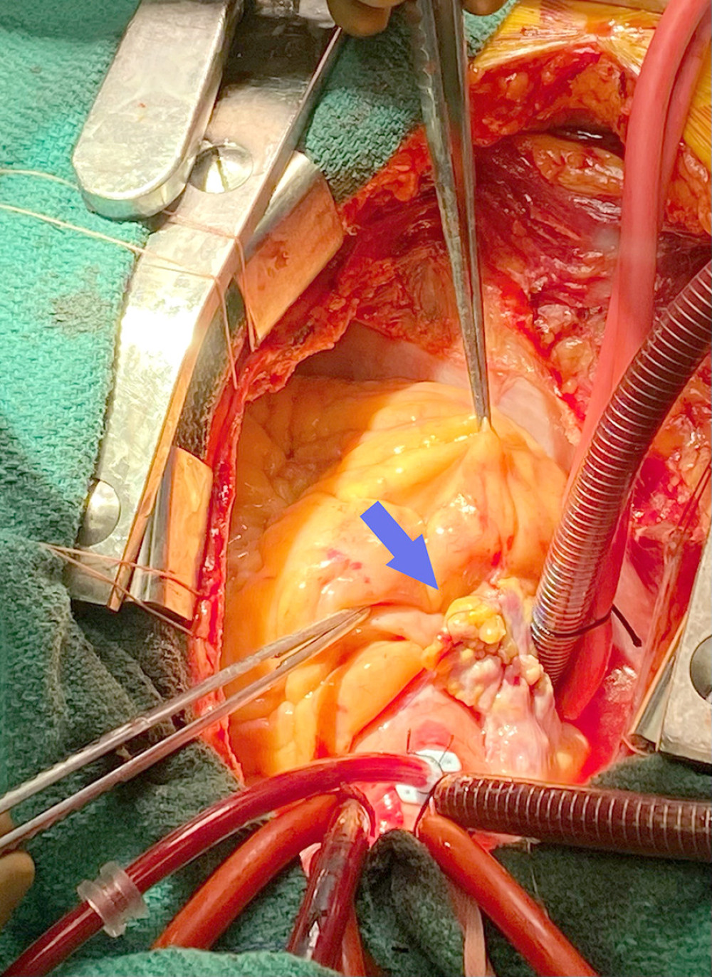 Intraoperative image. The tumor mass is invading the right ventricle into the epicardium and the surface of the aorta.