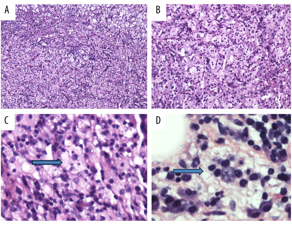 Histopathological analysis showing aggregates of large histiocytes, with clear cytoplasm and intervening inflammatory cells that produce an alternating dark and light effects; (A) ×40 and (B) ×200. The large histiocytes have clear cytoplasm that include whole cells (emperipolesis) in the lesion of the right atrium, (C) ×400, and in the periaortic lesion, (D) ×600. Arrowheads indicate the emperipolesis.