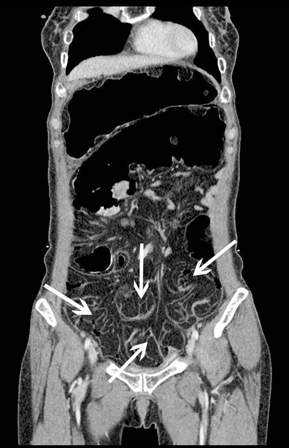 Abdominal contrast-enhanced computed tomography coronal image of a 58-year-old woman with diffuse intestinal lipomatosis. The white arrow indicates multiple lipomas in the small intestine.