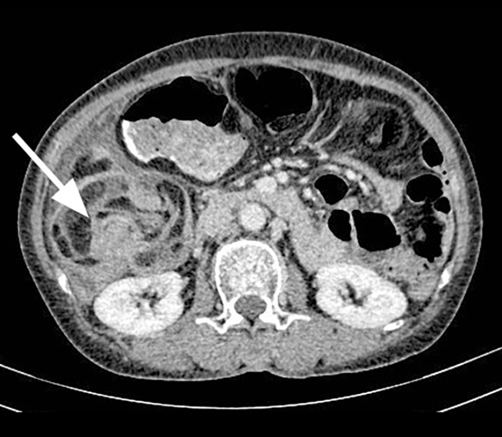 Abdominal enhanced computed tomography axial image of a 58-year-old woman with diffuse intestinal lipomatosis. The white arrows indicate the small intestine in the lower right abdomen is distributed in a vortex pattern.