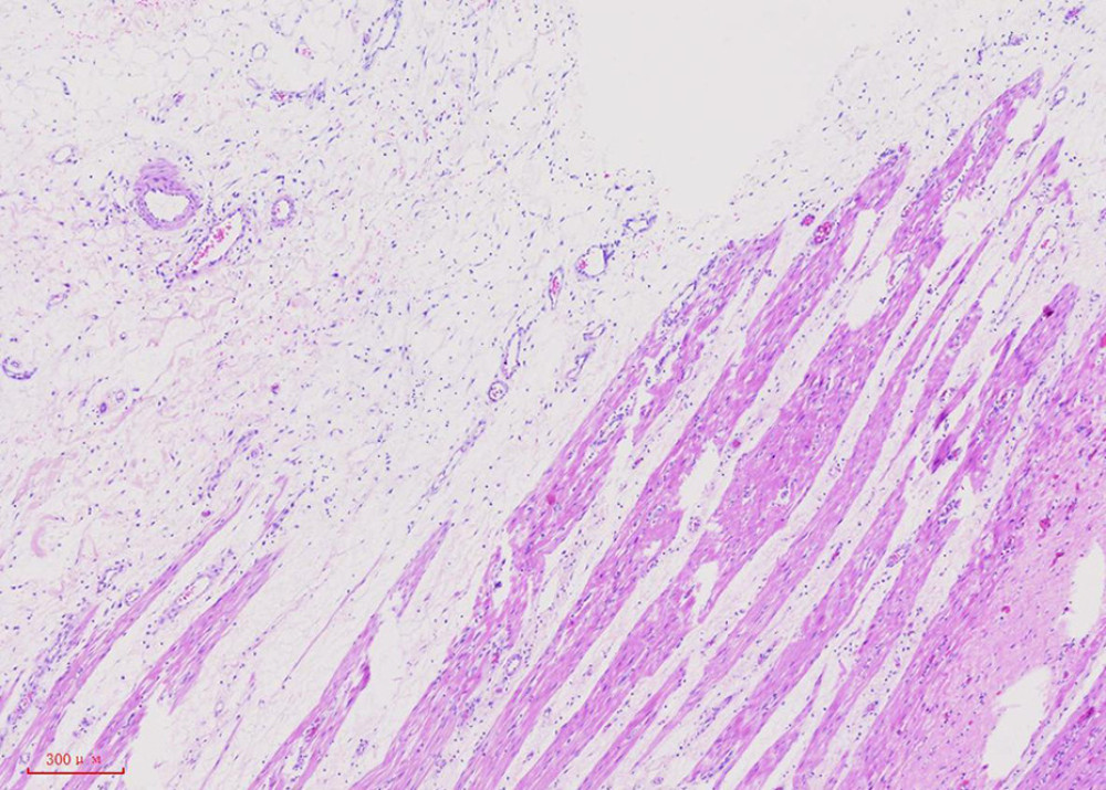 A photomicrograph of the histopathology of the small bowel from a 58-year-old woman with diffuse intestinal lipomatosis. The submucosal muscle is replaced by benign mature adipose tissue that has an infiltrative pattern but shows no evidence of malignancy. The histopathology is diagnostic for intestinal lipomatosis. Hematoxylin and eosin staining; magnification ×4.