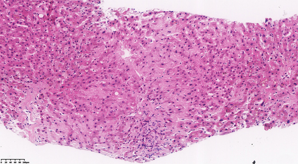Liver biopsy histology, 200× photomicrographs. Hematoxylin and eosin staining showing collagen-type extracellular material deposition.